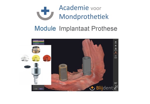 [AvM-MD-IMP] MoDule IMplantaat Prothese